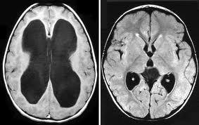 hemianopsi Cerebellum