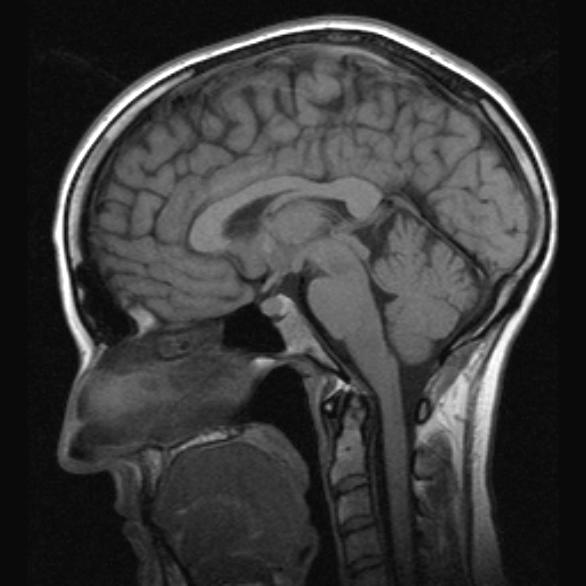 jan fagius, neurologkliniken Blodstamcellstransplantation vid MS har vi funnit ett sätt att bota