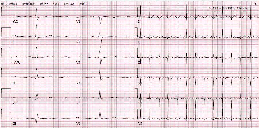 EKG 4 10