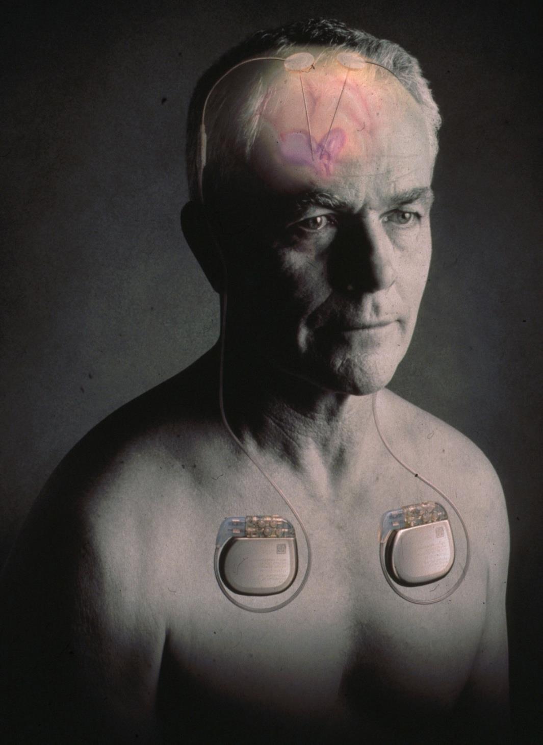 Deep Brain Stimulation Djup