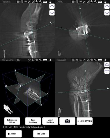 Finns också i utförande med bildförstärkare: C-båge Ziehm Vision Vario 3D Ziehm Vision Vario 3D har precis samma genomlysningsdata, mått och prestanda som Ziehm Vision FD Vario 3D, men detektorn är