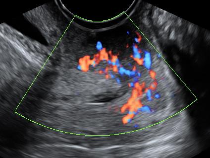 Subjektiv ultraljudsbedömning kunde prediktera icke-ovariellt ursprung med sensitivitet på 70% specificitet 82% Metastaser: oftare mobila, avsaknad av omentmetastaser pancreas ventrikel colon