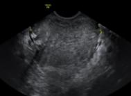 Prospektiv tvåcenter studie (n=55), Lund & Rom Epstein et al, Ultrasound Obstet Gynecol 2010 Hur ser en livmoderhalscancer ut vid ultraljudsundersökning?