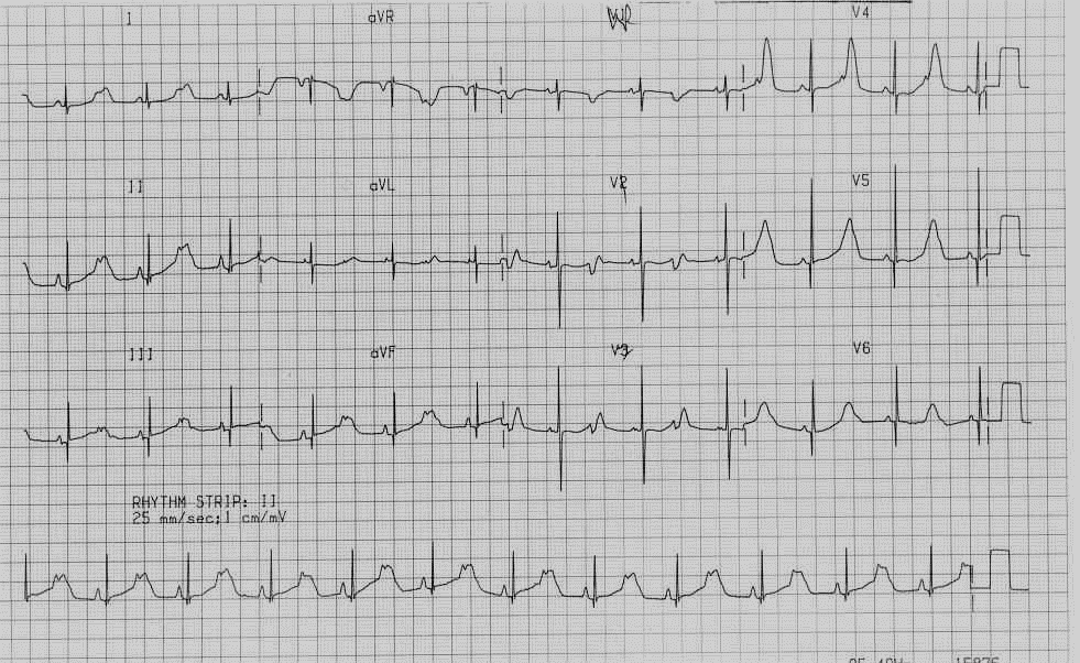 Long QT Syndrome in a 16-year-old girl QT=520