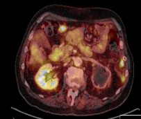 Scintigrafi registrering med Gammakamera Scintigrafi Skelettscintigrafi Injektion av 99 Tc Upptag i skelett osteoblastaktivitet Positronemissionstomografi (PET) Detektion of gammastrålar generade av