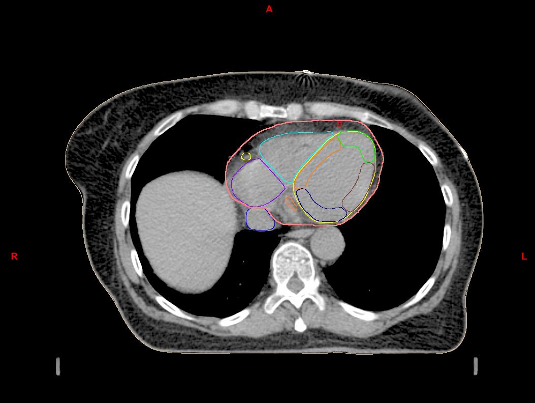 Cardiac dosimetry for structures within the heart Dr Fran Duane, Radiation Oncologist, CTSU Right Ventricle RCA: Mid LAD: Distal LV: