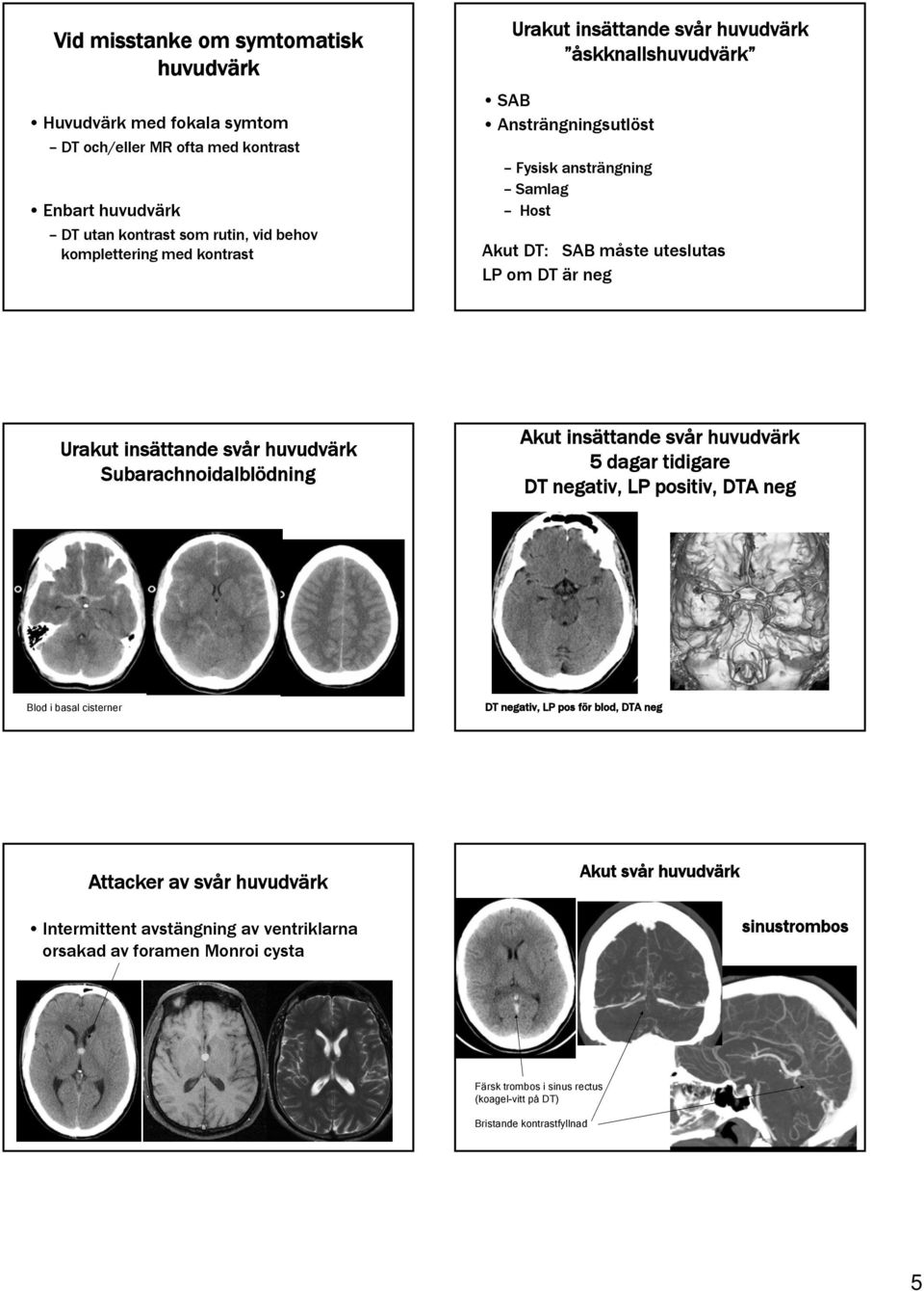 Subarachnoidalblödning Akut insättande svår huvudvärk 5 dagar tidigare DT negativ, LP positiv, DTA neg Blod i basal cisterner DT negativ, LP pos för blod, DTA neg Attacker av svår