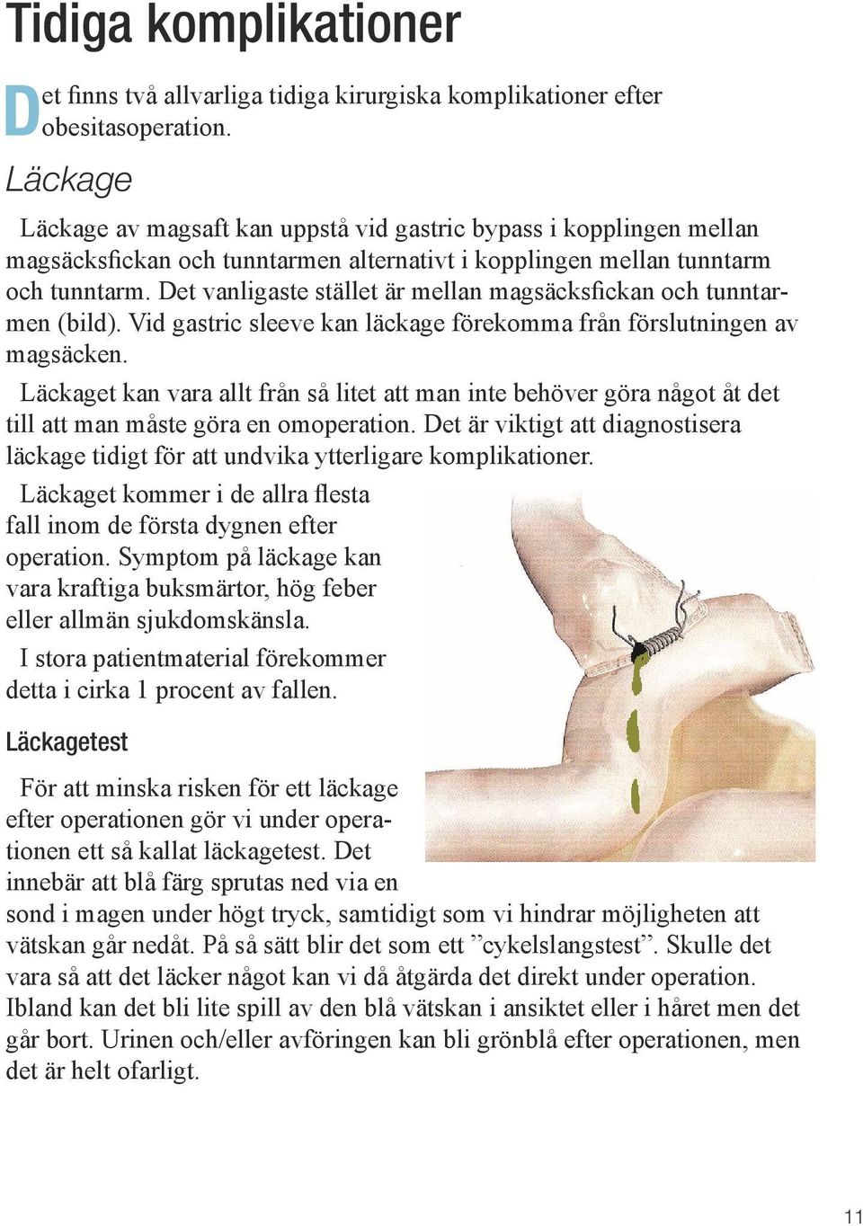 Det vanligaste stället är mellan magsäcksfickan och tunntarmen (bild). Vid gastric sleeve kan läckage förekomma från förslutningen av magsäcken.