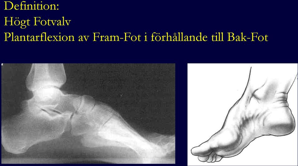 Plantarflexion av