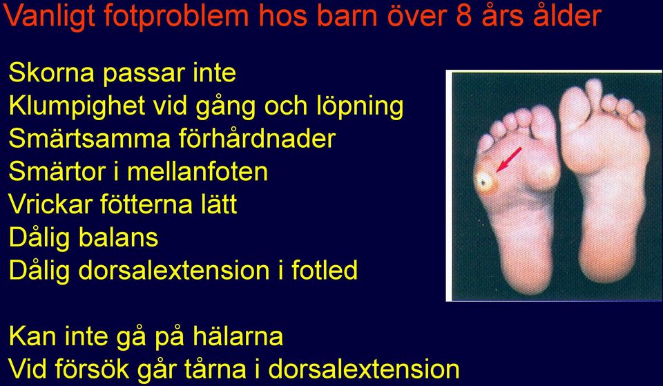 mellanfoten Vrickar fötterna lätt Dålig balans Dålig