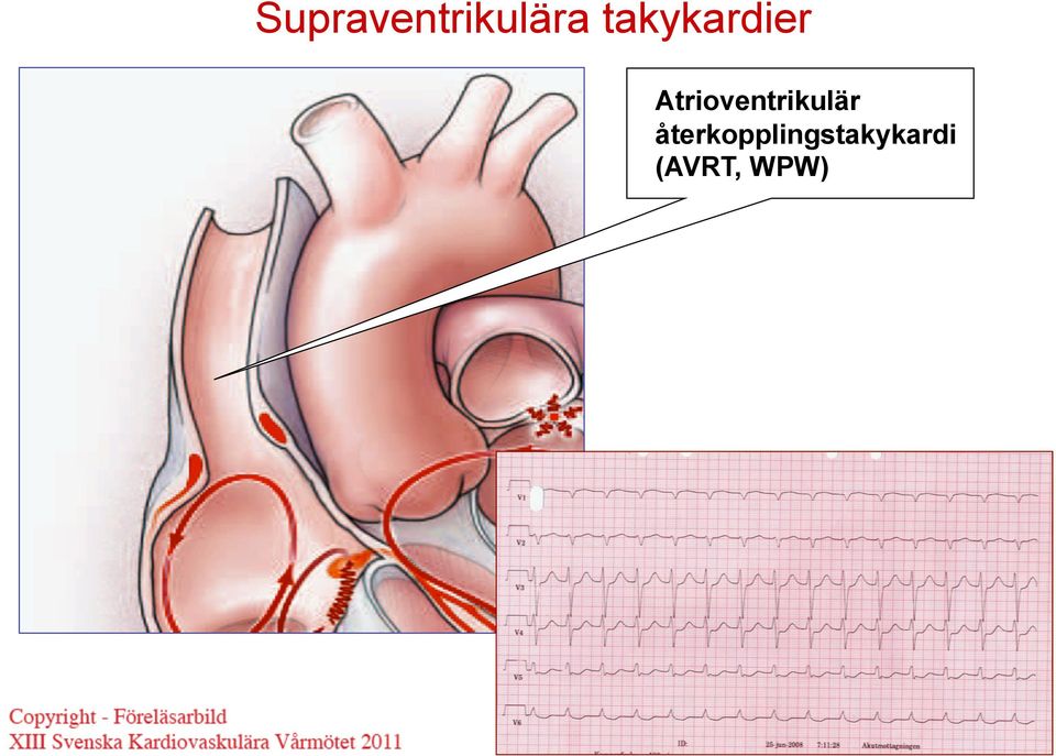 Atrioventrikulär