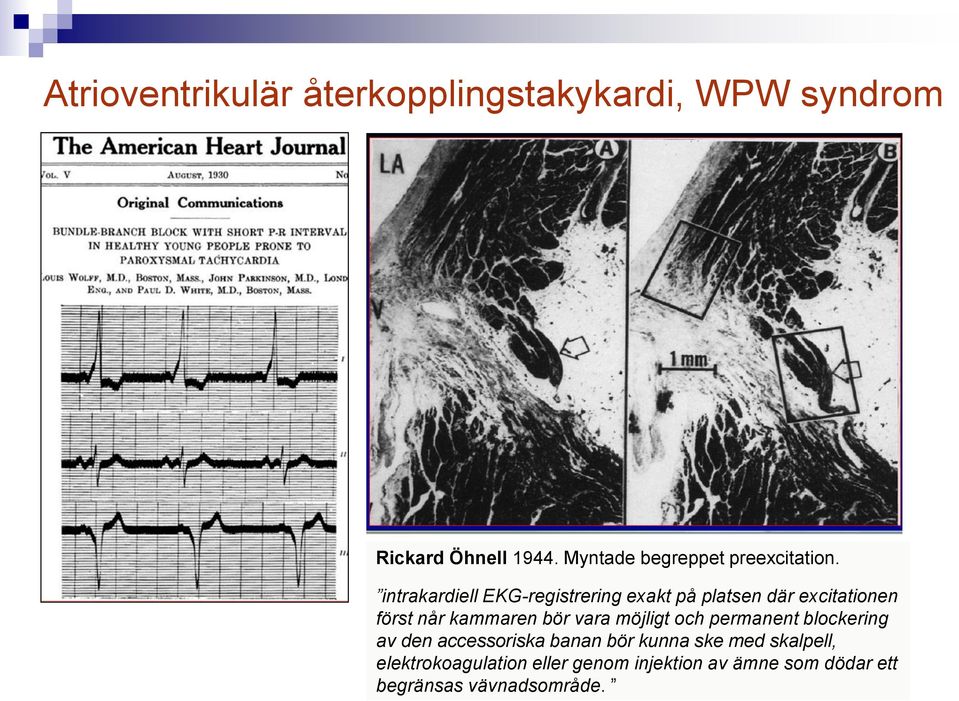 intrakardiell EKG-registrering exakt på platsen där excitationen först når kammaren bör vara