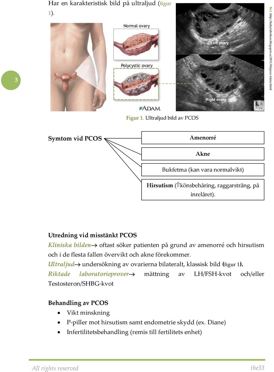 Utredning vid misstänkt PCOS Kliniska bilden oftast söker patienten på grund av amenorré och hirsutism och i de flesta fallen övervikt och akne förekommer.