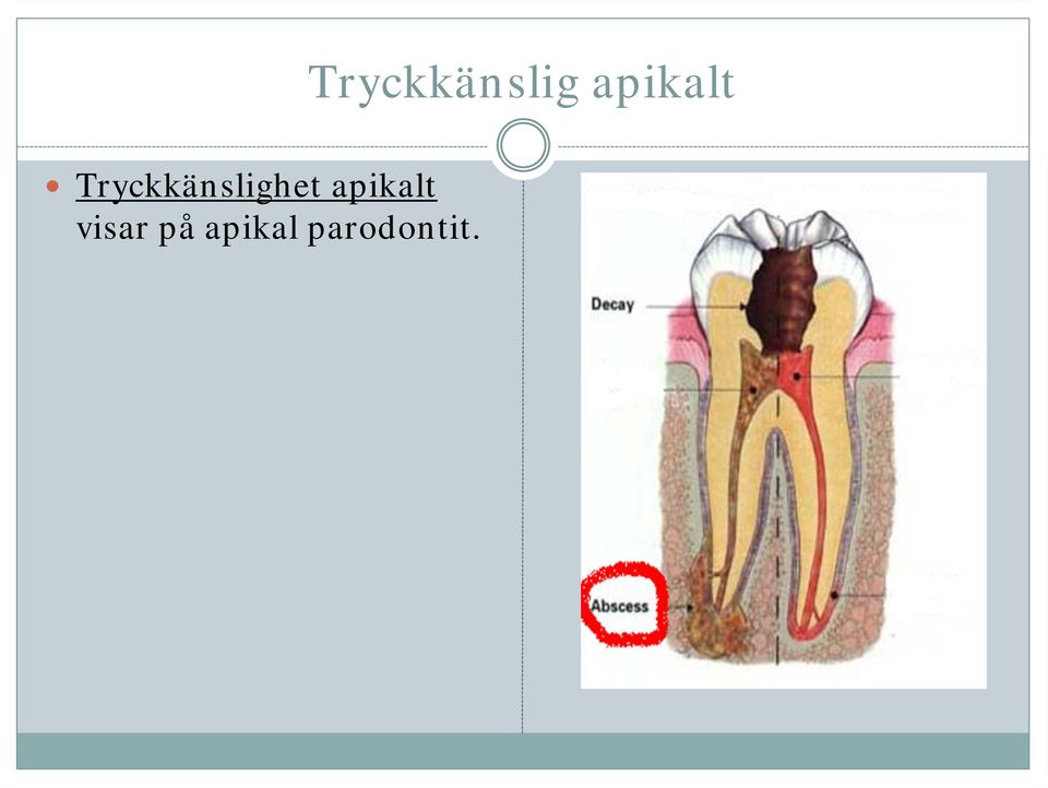 apikal parodontit.