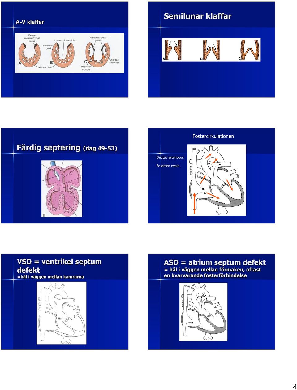 defekt =hål i väggen mellan kamrarna ASD = atrium septum defekt =