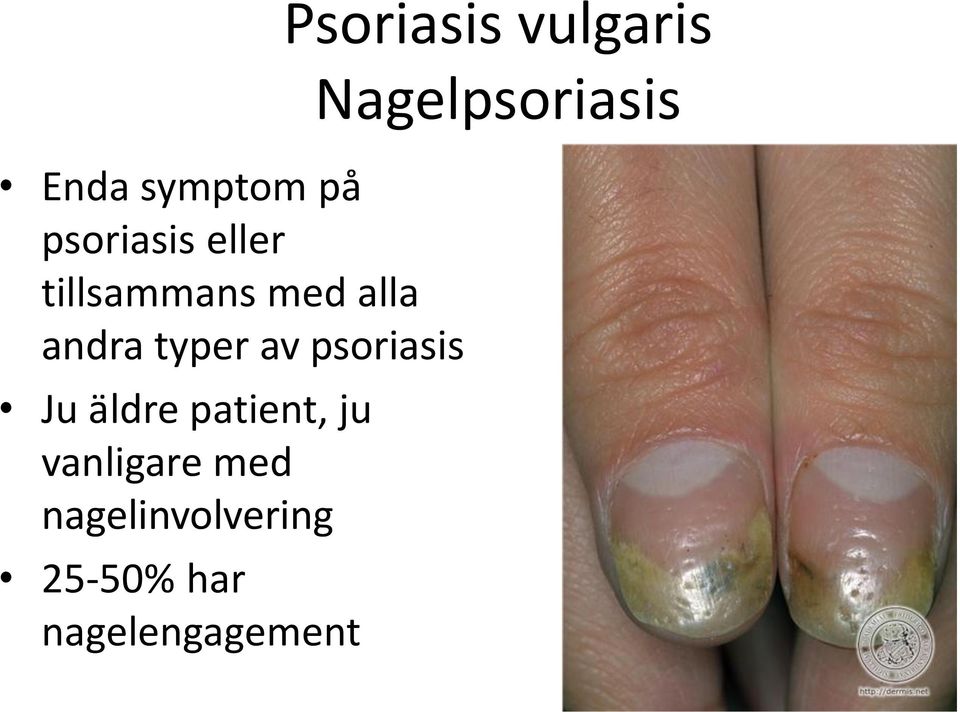 ju vanligare med nagelinvolvering 25-50% har