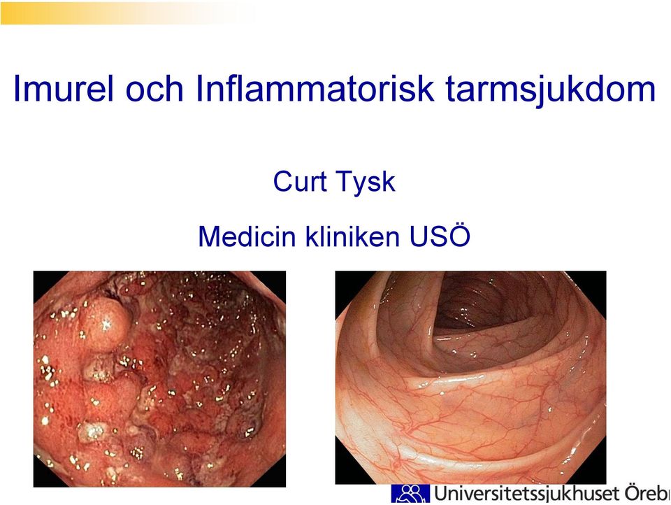 tarmsjukdom Curt