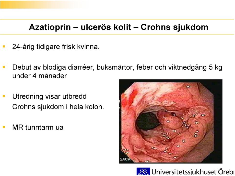 Debut av blodiga diarréer, buksmärtor, feber och