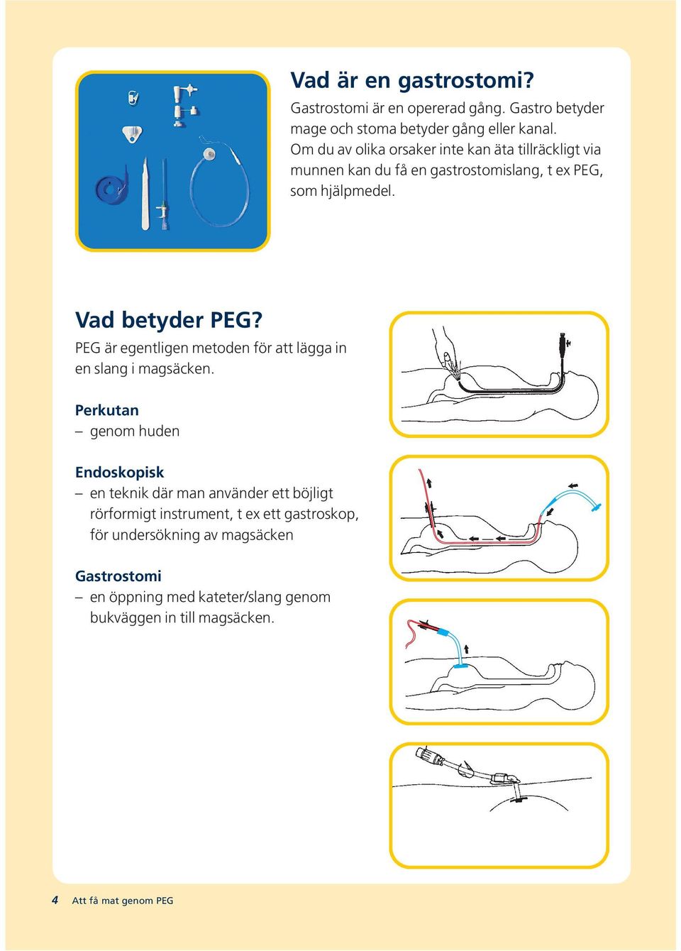 PEG är egentligen metoden för att lägga in en slang i magsäcken.