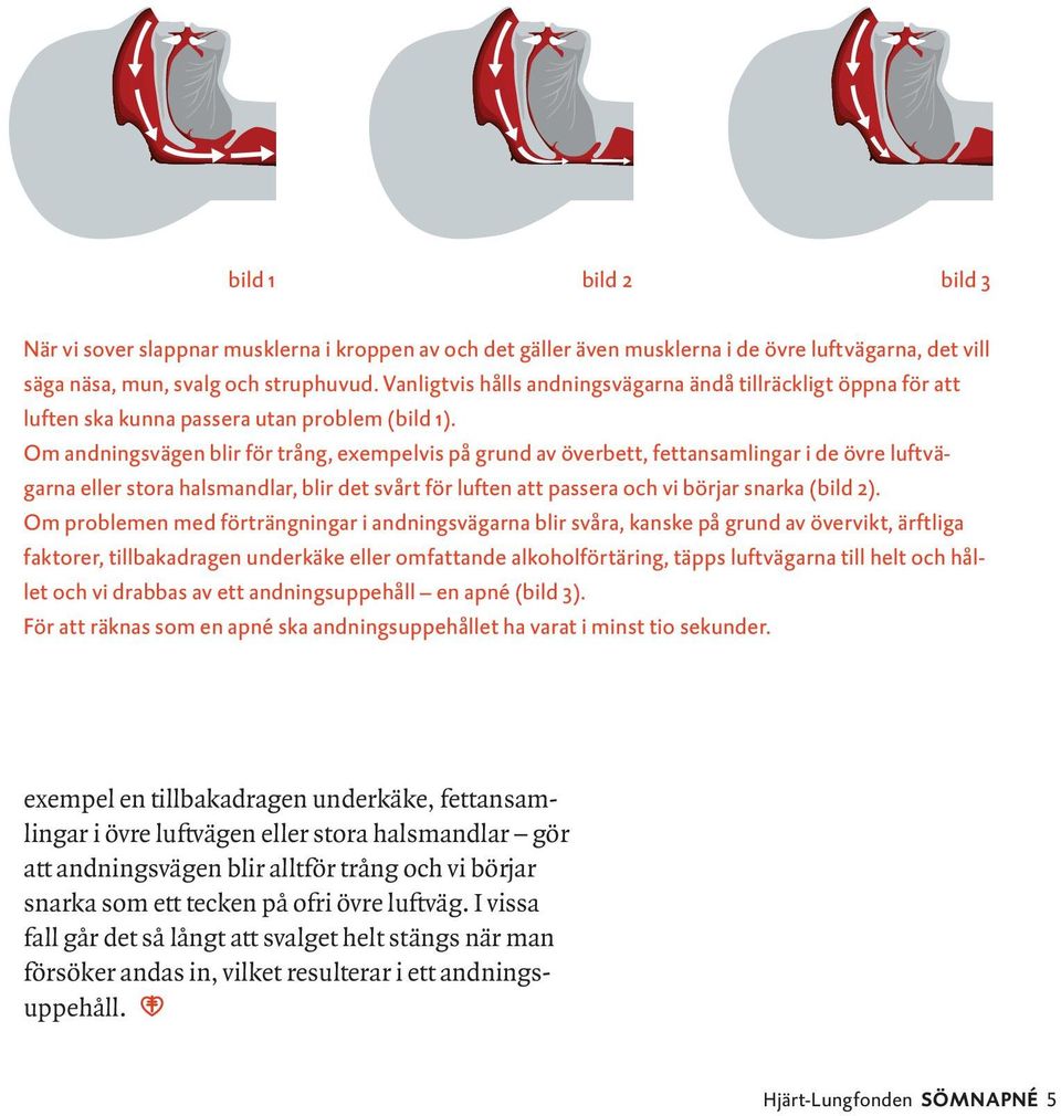 Om andningsvägen blir för trång, exempelvis på grund av överbett, fettansamlingar i de övre luftvägarna eller stora halsmandlar, blir det svårt för luften att passera och vi börjar snarka (bild 2).