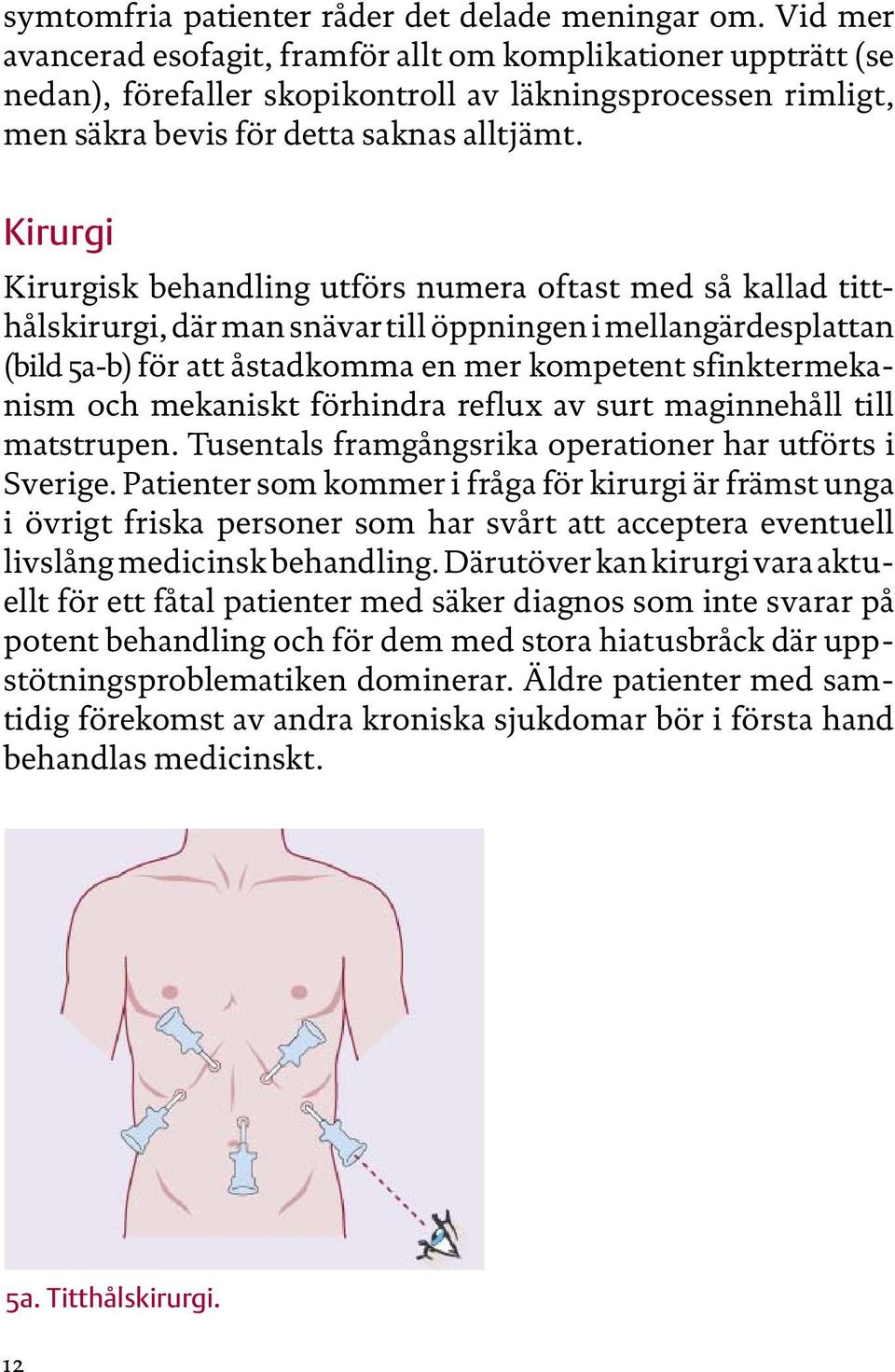 Kirurgi Kirurgisk behandling utförs numera oftast med så kallad titthålskirurgi, där man snävar till öppningen i mellangärdesplattan (bild 5a-b) för att åstadkomma en mer kompetent sfinktermeka -
