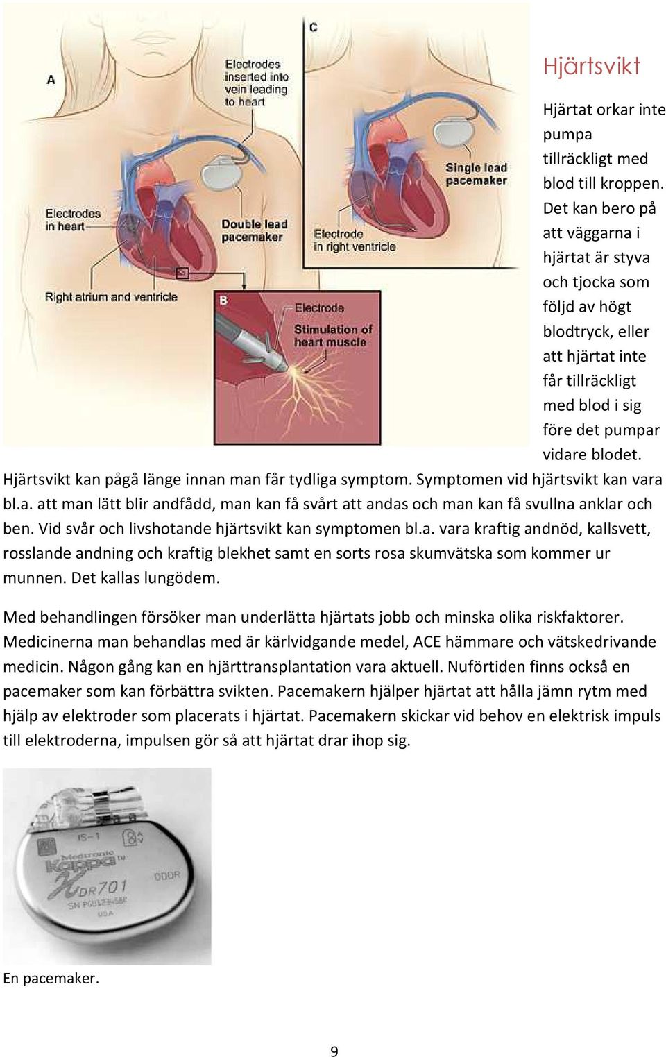 Hjärtsvikt kan pågå länge innan man får tydliga symptom. Symptomen vid hjärtsvikt kan vara bl.a. att man lätt blir andfådd, man kan få svårt att andas och man kan få svullna anklar och ben.