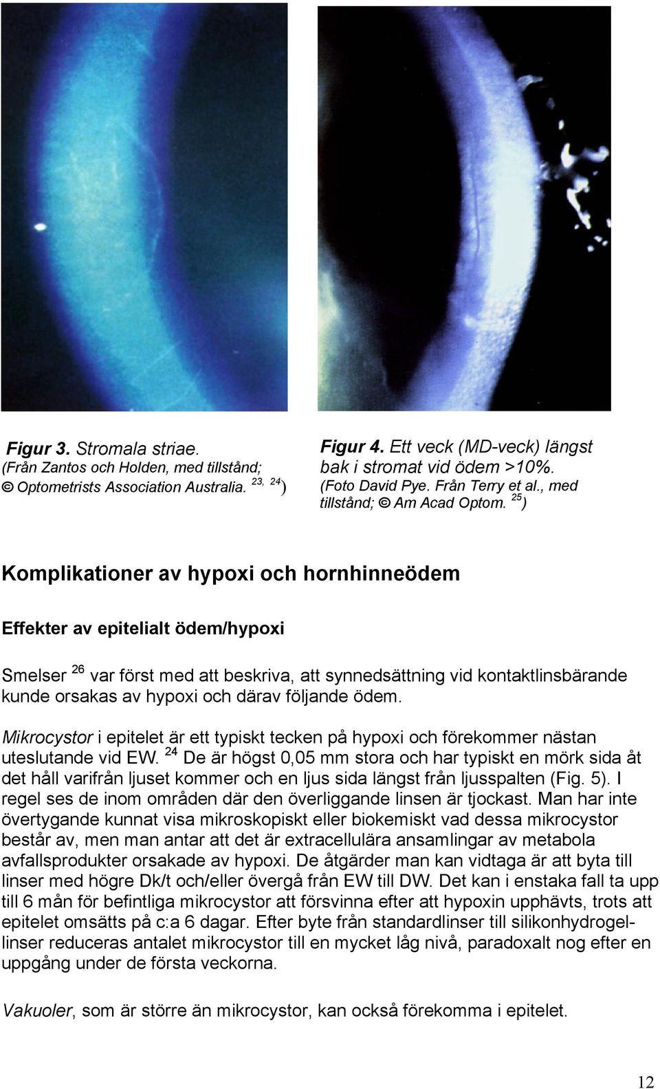 25 ) Komplikationer av hypoxi och hornhinneödem Effekter av epitelialt ödem/hypoxi Smelser 26 var först med att beskriva, att synnedsättning vid kontaktlinsbärande kunde orsakas av hypoxi och därav