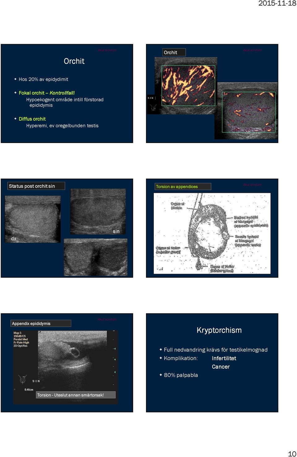 testis Status post orchit sin Torsion av appendices dx sin Appendix epididymis Kryptorchism