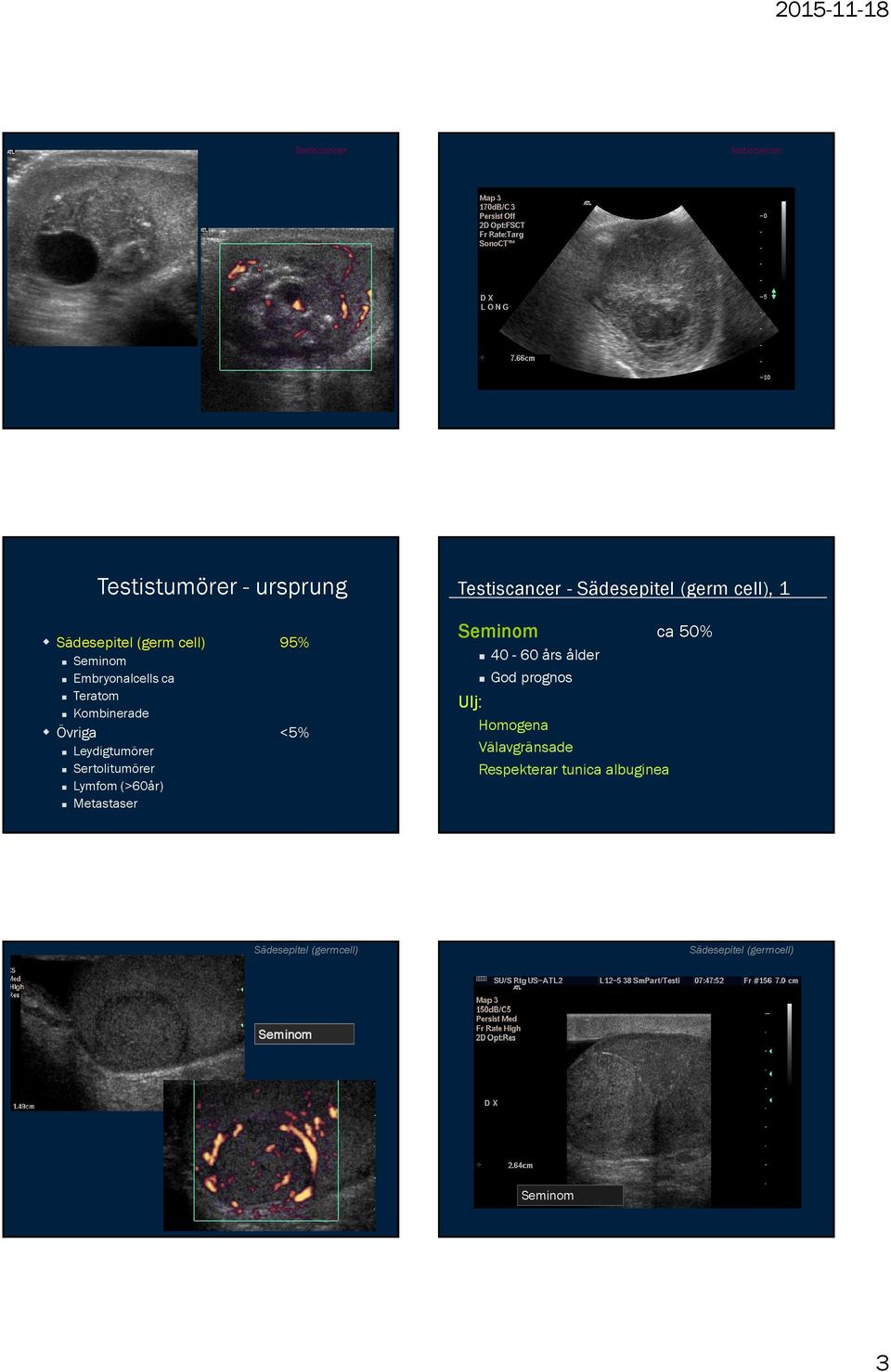 Metastaser Testiscancer - Sädesepitel (germ cell), 1 Seminom ca 50% 40-60 års ålder God prognos