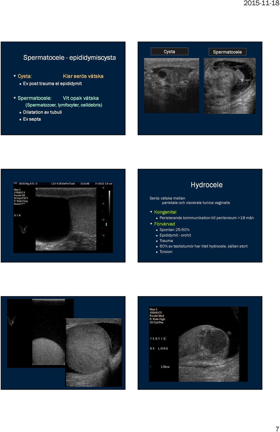 Serös vätska mellan parietala och viscerala tunica vaginalis Kongenital Peristerande kommunikation till