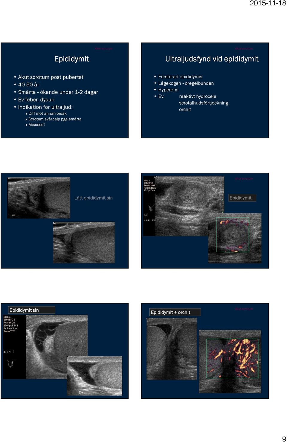 Abscess? Förstorad epididymis Lågekogen - oregelbunden Hyperemi Ev.