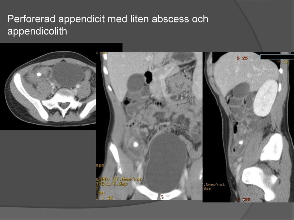 liten abscess