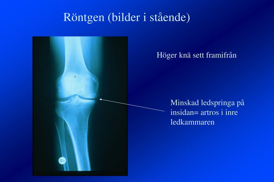 Minskad ledspringa på