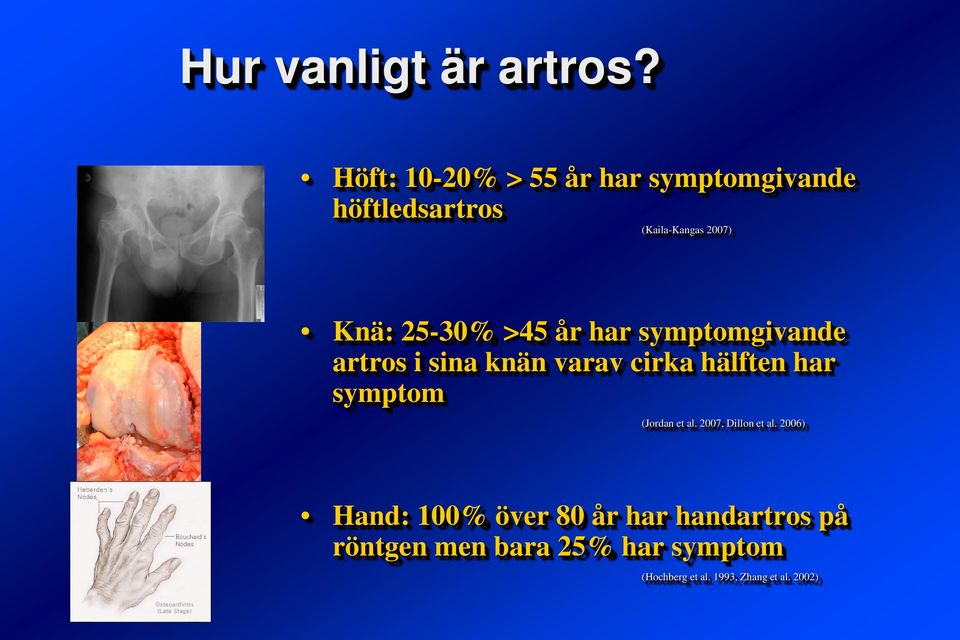 25-30% >45 år har symptomgivande artros i sina knän varav cirka hälften har symptom