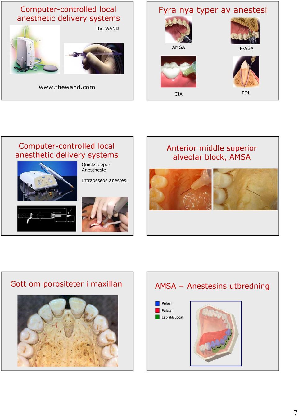 com CIA PDL Computer-controlled local anesthetic delivery systems Quicksleeper Anesthesie