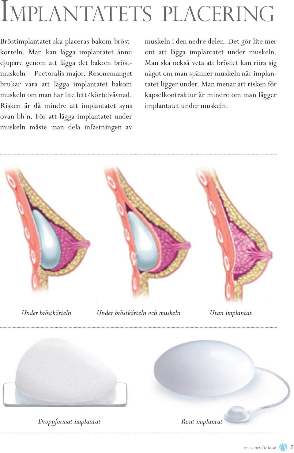 För att lägga implantatet under muskeln måste man dela infästningen av muskeln i den nedre delen. Det gör lite mer ont att lägga implantatet under muskeln.