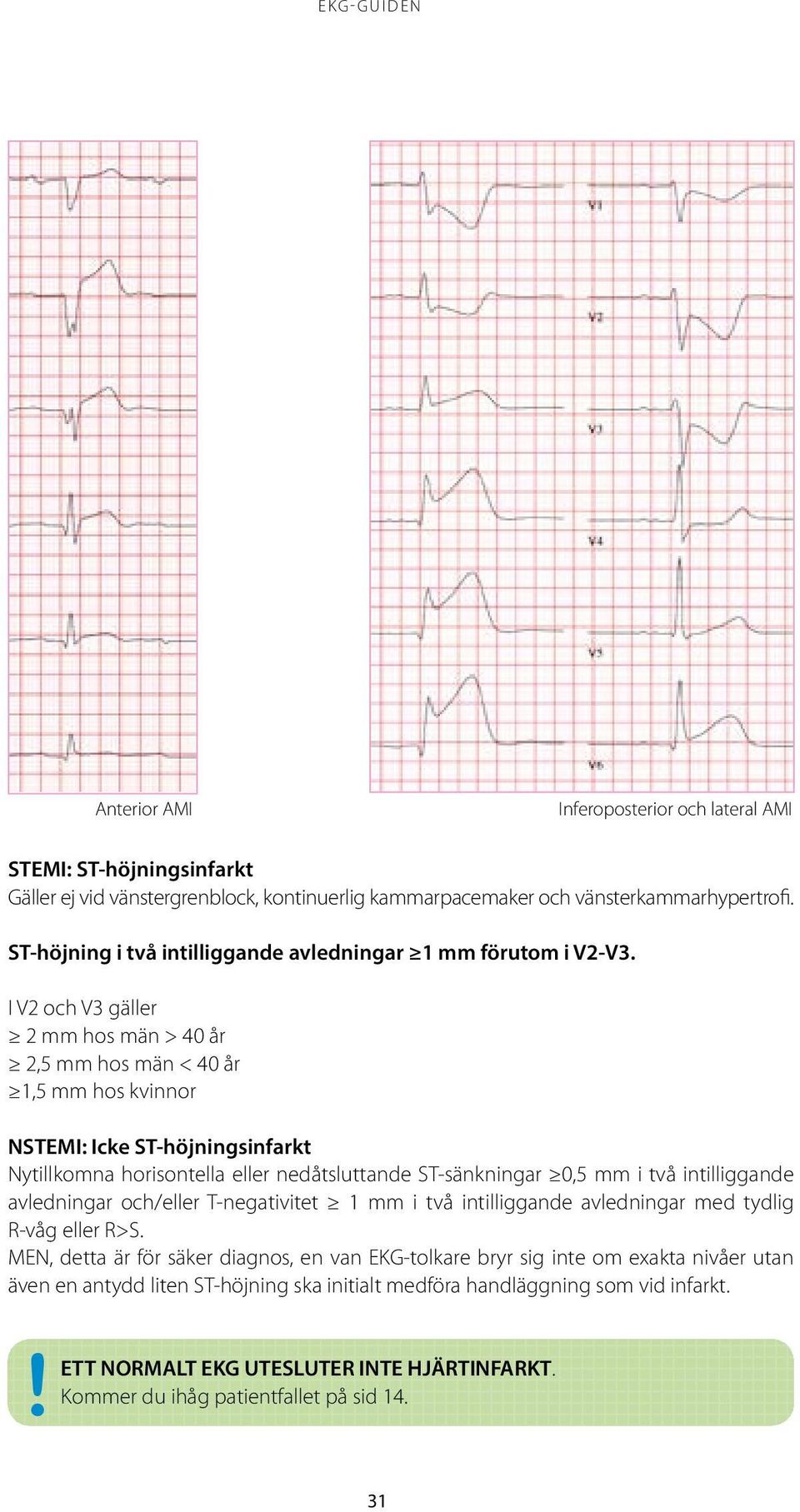 I V2 och V3 gäller 2 mm hos män > 40 år 2,5 mm hos män < 40 år 1,5 mm hos kvinnor NSTEMI: Icke ST-höjningsinfarkt Nytillkomna horisontella eller nedåtsluttande ST-sänkningar 0,5 mm i två