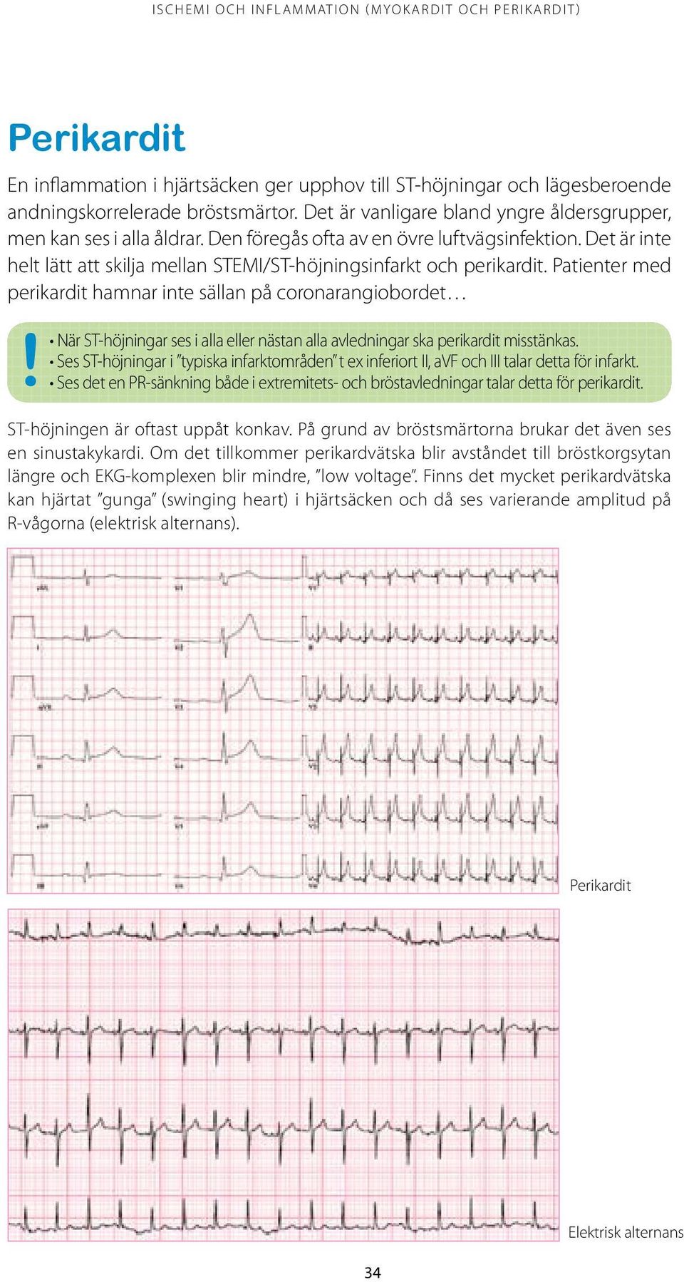 Patienter med perikardit hamnar inte sällan på coronarangiobordet! När ST-höjningar ses i alla eller nästan alla avledningar ska perikardit misstänkas.