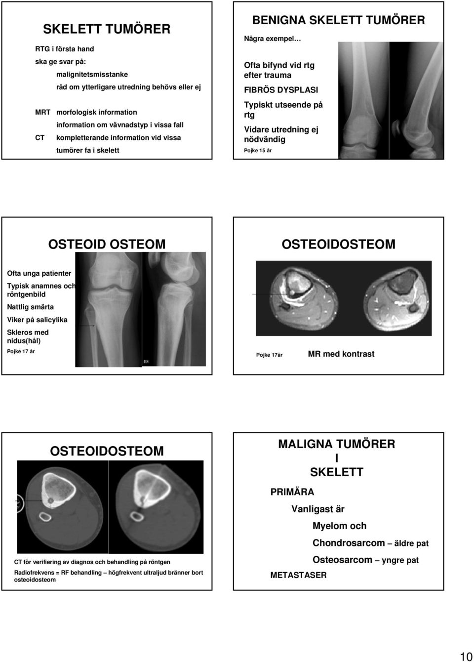 Pojke 15 år OSTEOID OSTEOM OSTEOIDOSTEOM Ofta unga patienter Typisk anamnes och röntgenbild Nattlig smärta Viker på salicylika Skleros med nidus(hål) Pojke 17 år Pojke 17år MR med kontrast