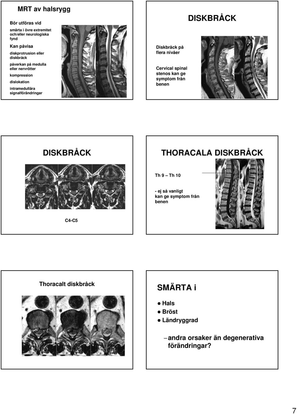 flera nivåer Cervical spinal stenos kan ge symptom från benen DISKBRÅCK THORACALA DISKBRÅCK Th 9 Th 10 - ej så vanligt kan