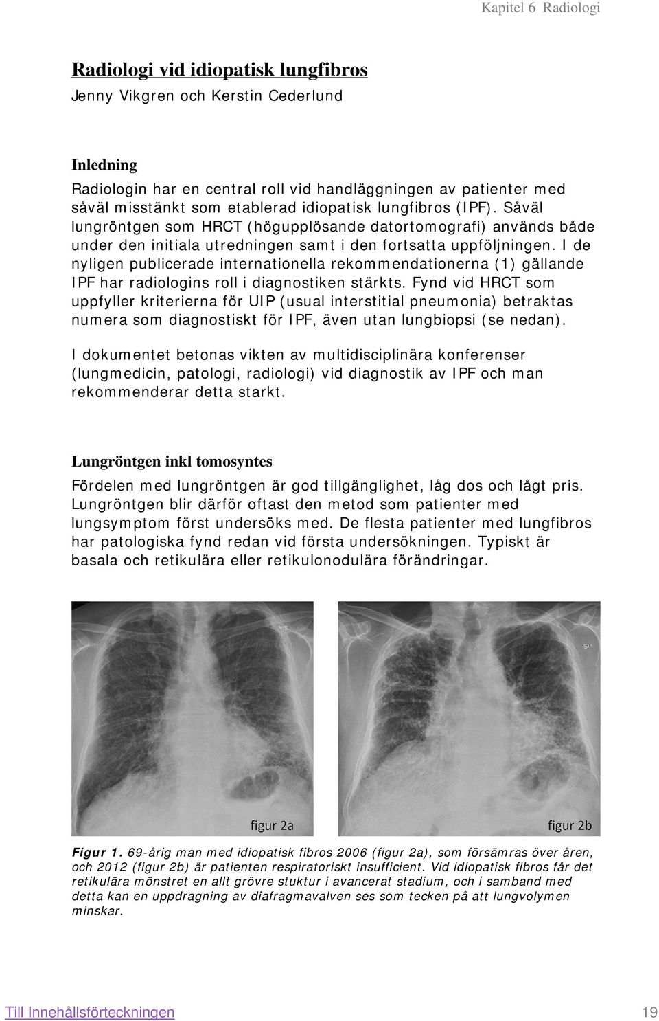 I de nyligen publicerade internationella rekommendationerna (1) gällande IPF har radiologins roll i diagnostiken stärkts.