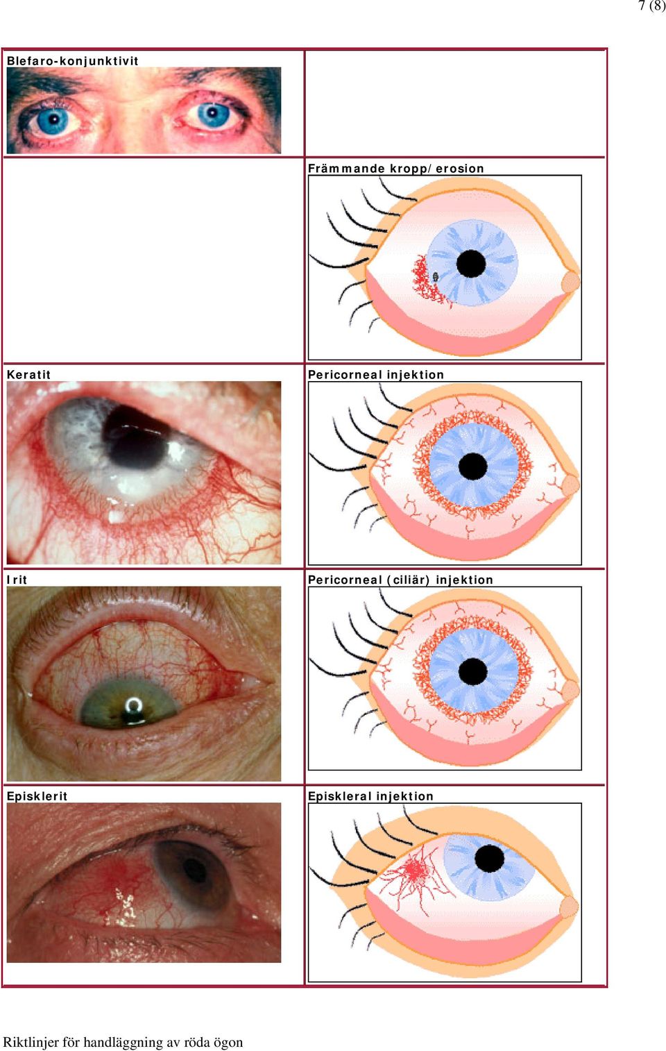 injektion Irit Pericorneal (ciliär)