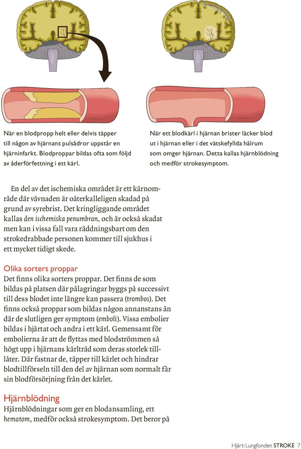 En del av det ischemiska området är ett kärnområde där vävnaden är oåterkalleligen skadad på grund av syrebrist.