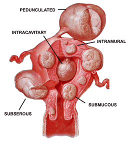 MYOMA UTERI C E L I N