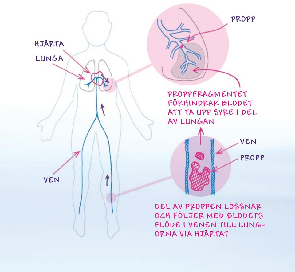 Propp Ven Del av proppen lossnar och följer