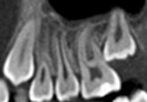 SENT VÄXELBETT Uttalade trång- och felställningar Djupa bett med traumatisk gingival påbitning (subjektiva symptom) Eruption 7:or Retinerade tänder 55 Varför erupterar inte