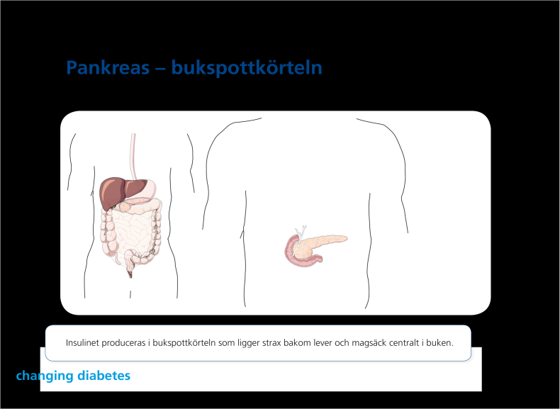 Vad är diabetes? Diabetes är ett tillstånd med kroniskt högt blodsocker. Orsaken är en brist på hormonet insulin och/eller en försämrad effekt av insulin.