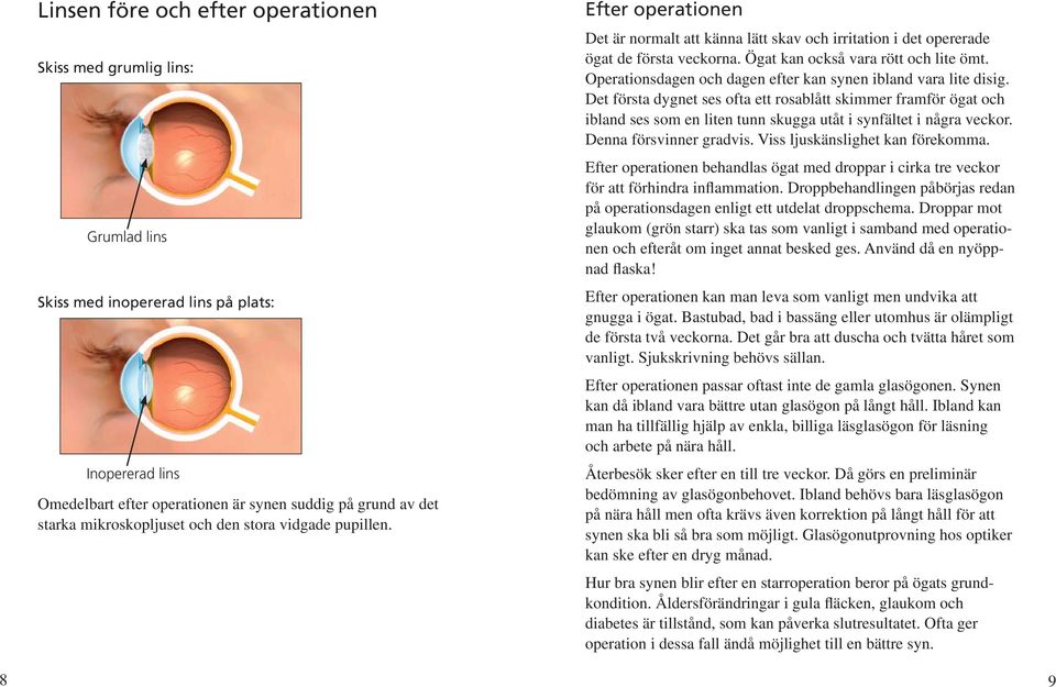 Operationsdagen och dagen efter kan synen ibland vara lite disig. Det första dygnet ses ofta ett rosablått skimmer framför ögat och ibland ses som en liten tunn skugga utåt i synfältet i några veckor.