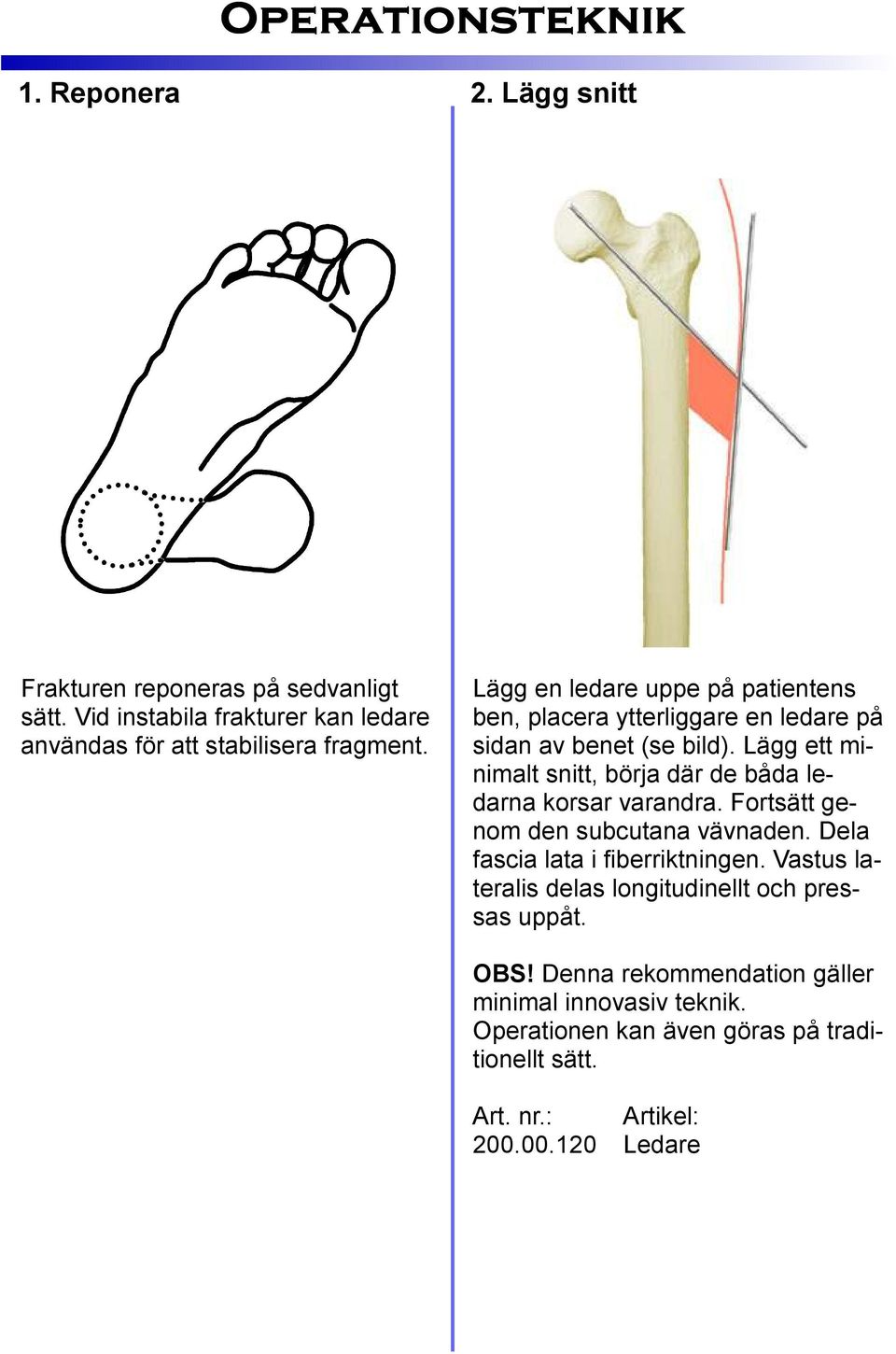 Lägg en ledare uppe på patientens ben, placera ytterliggare en ledare på sidan av benet (se bild).