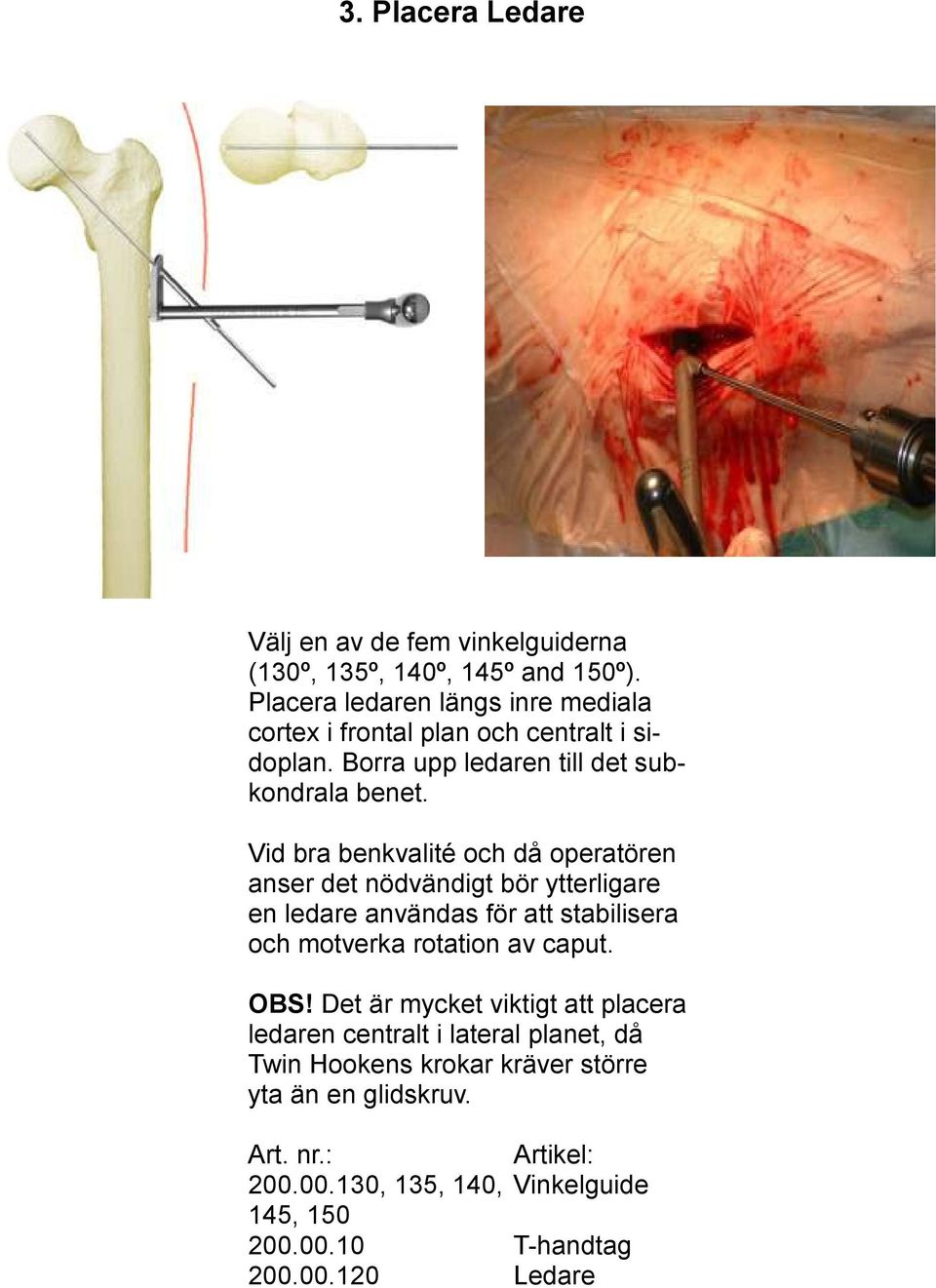 Vid bra benkvalité och då operatören anser det nödvändigt bör ytterligare en ledare användas för att stabilisera och motverka rotation av caput.